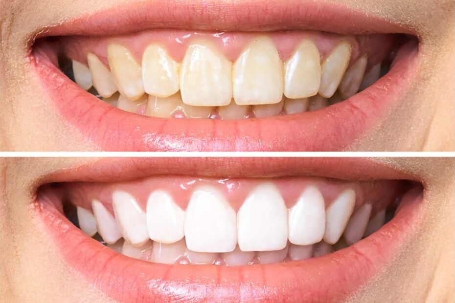 Dentes brancos em pouco tempo: Um guia completo com receita caseira