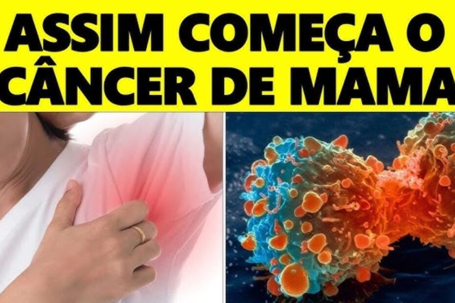 Como Identificar os Primeiros Sinais do Câncer de Mama: Um Guia Completo