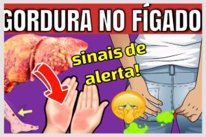 8 Sinais que Indicam Gordura no Fígado: Como Identificar